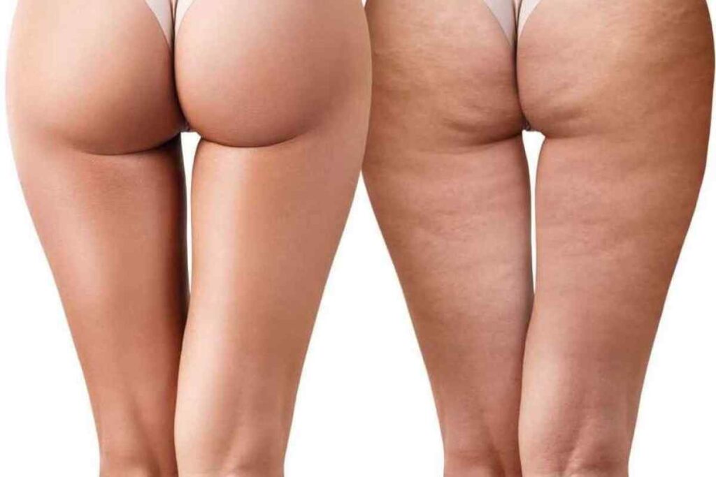 як прибрати целюліт на попі