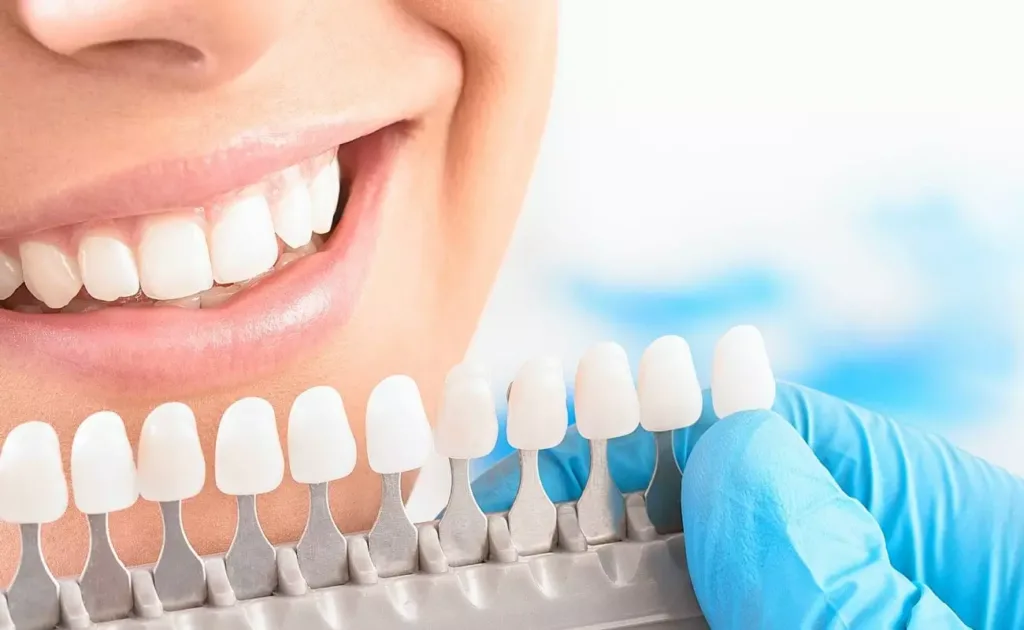 отбеливание зубов Киев