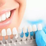 отбеливание зубов Киев