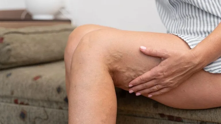 varikoz-metody-lecheniya_Xr62uid.original