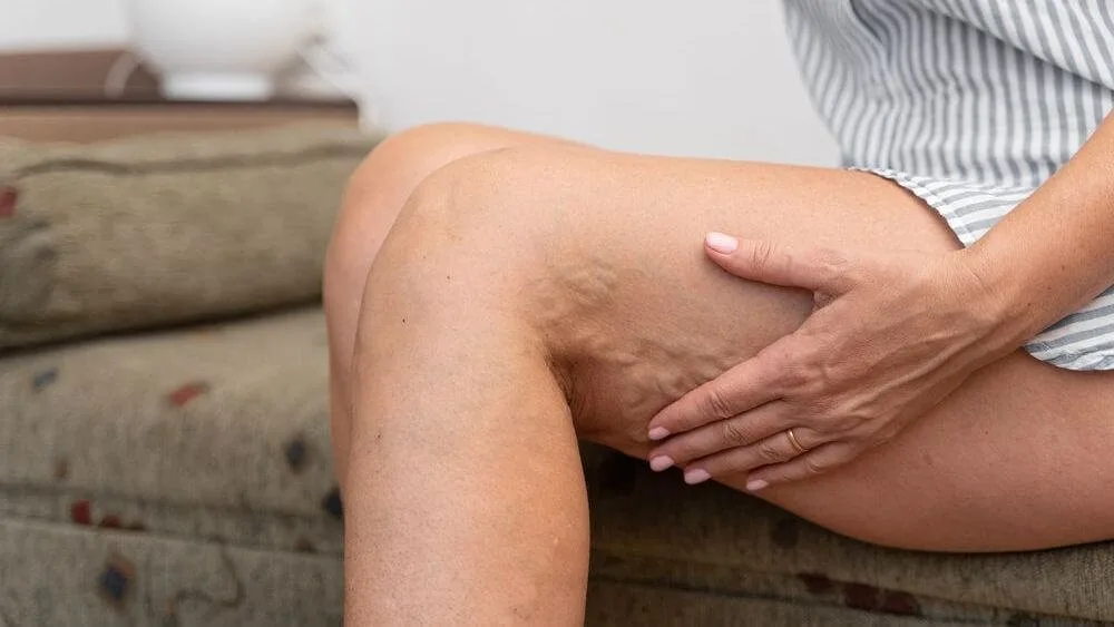 varikoz-metody-lecheniya_Xr62uid.original