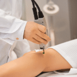 лікування варикозу