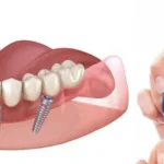 Имплантация зубов при диабете