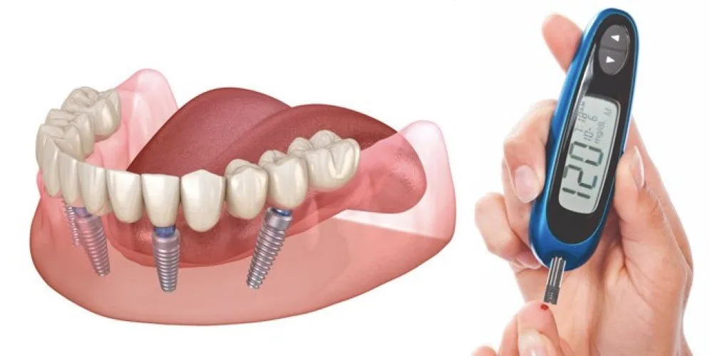 Имплантация зубов при диабете