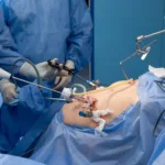 Рак товстої кишки операція