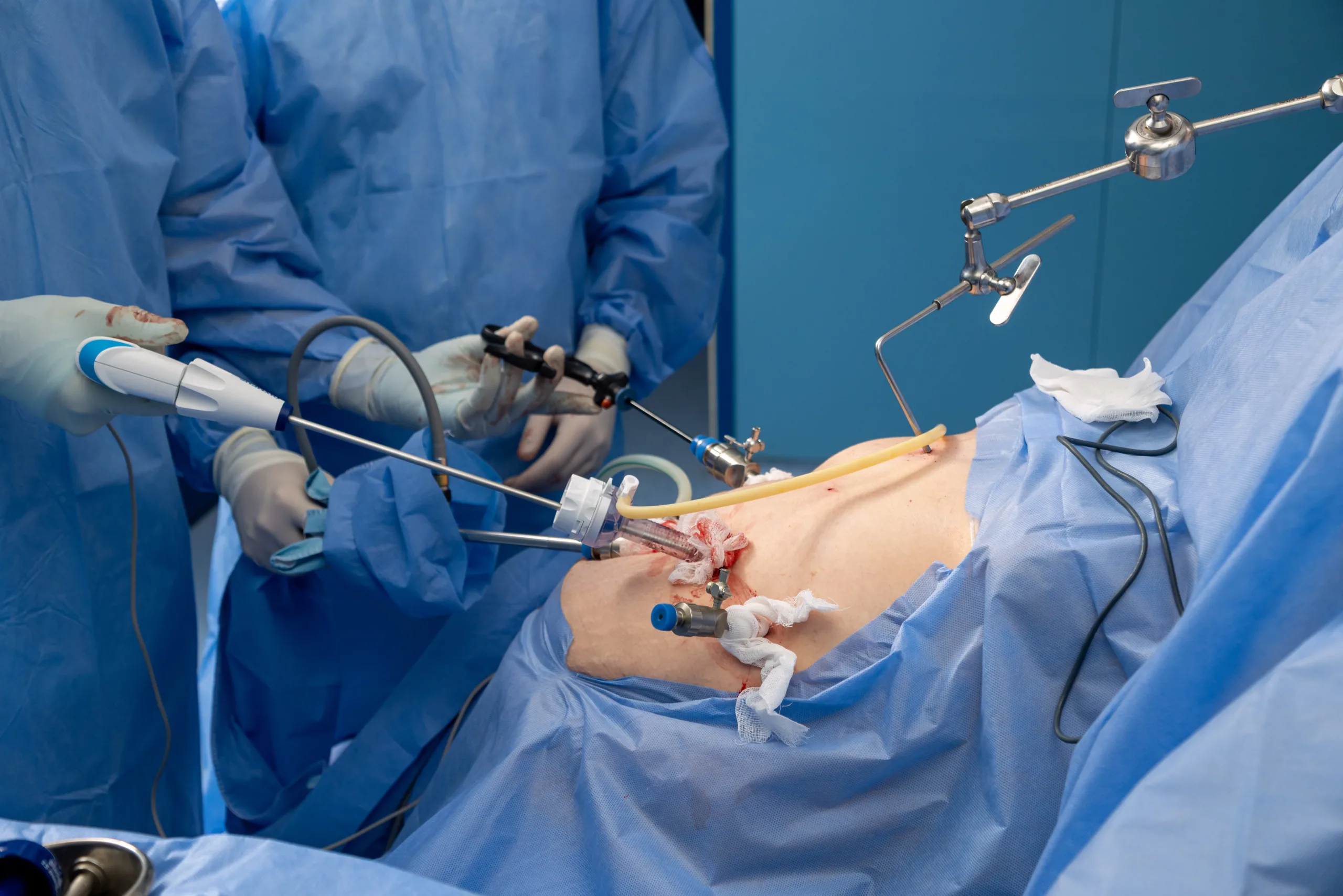 Рак товстої кишки операція