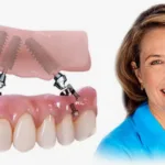 implantatsiya-zubov-na-4-implantah