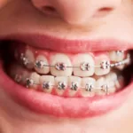braces-1-1024x734