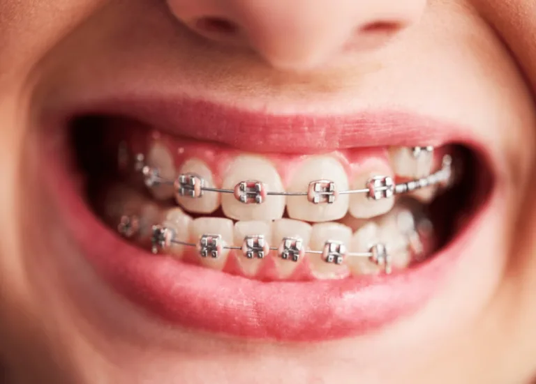 braces-1-1024x734